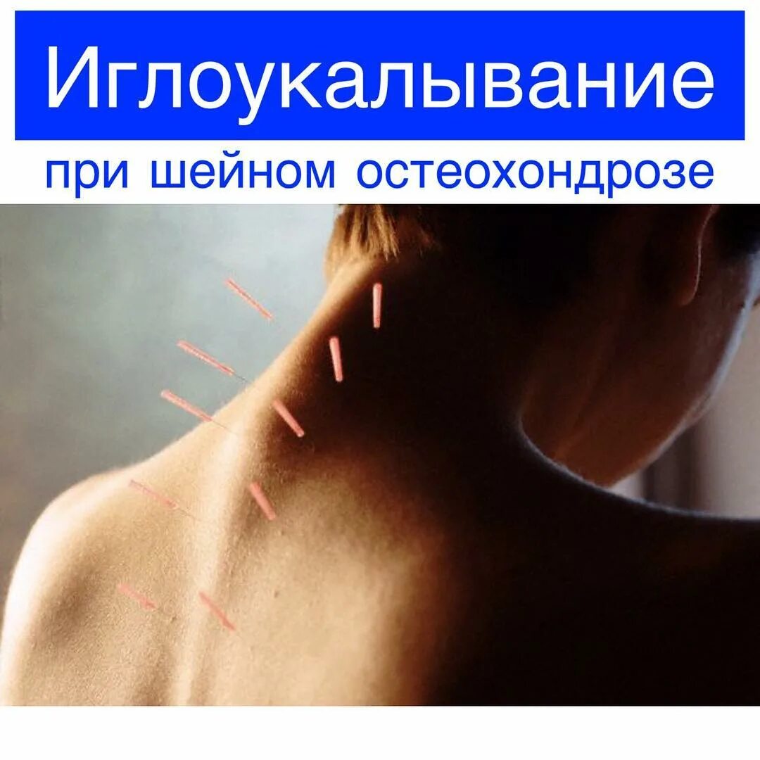 иглоукалывание при остеохондрозе шейного. иглоукалывание при остеохондрозе. иглотерапия шейный отдел позвоночника. что такое рефлексотерапия позвоночника. иглоукалывание при остеохондрозе шейного.