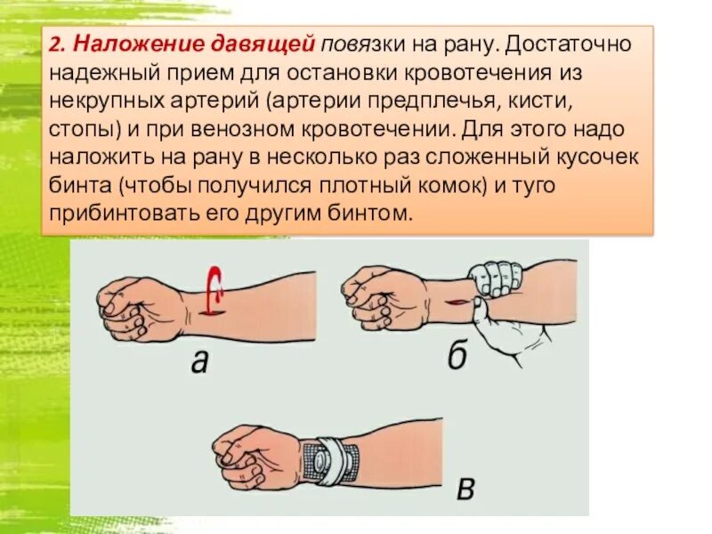 Наложение давящей повязки эффективно при