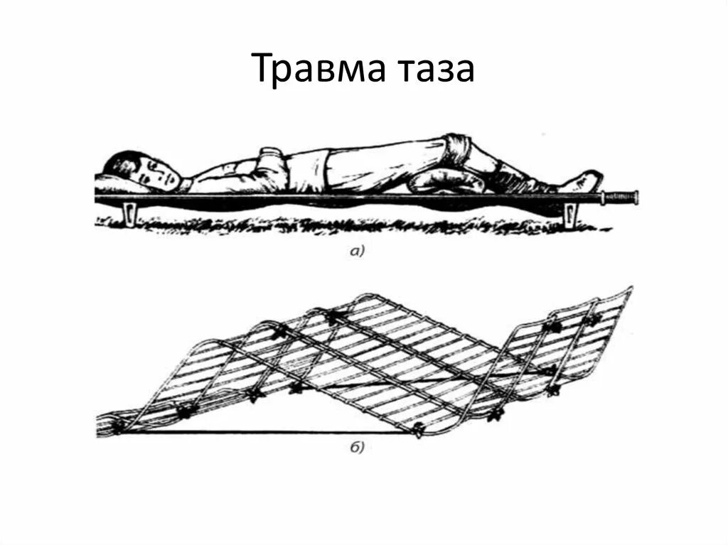 Ушиб таза код. Синдром длительного сдавления. вытяжка при травме таза. упражнения для сдавления тела противника.