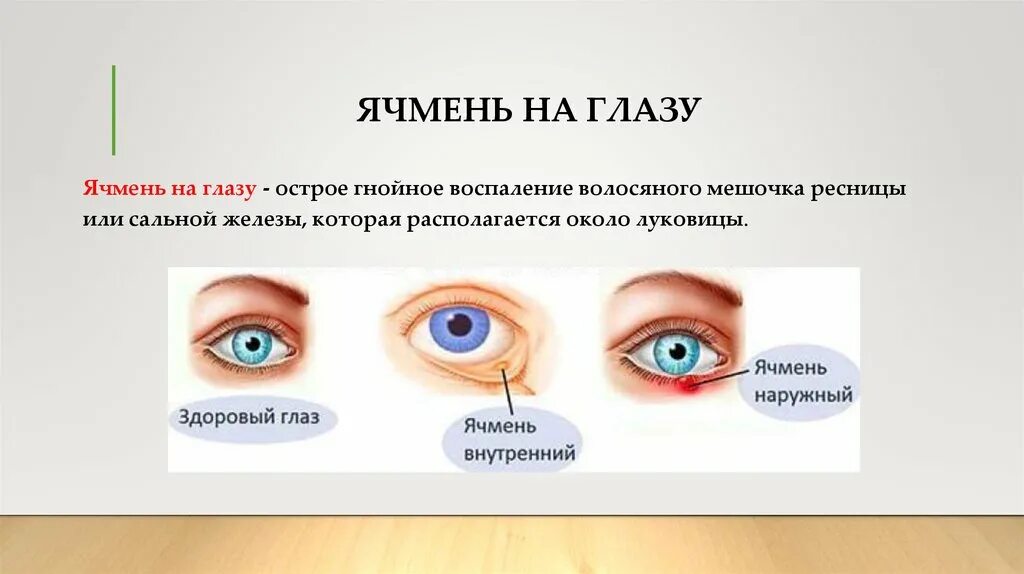 Ячмень что делать в домашних. Ячмень заболевание глаз. Воспаление глаза ячмень. Этапы развития ячменя на глазу.