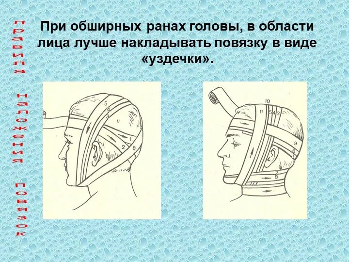 Повязка накладывается при повреждении затылка. Повязка на голову при травме. Наложение повязки при травме головы. Виды перевязок головы. Виды повязок при ранении головы.