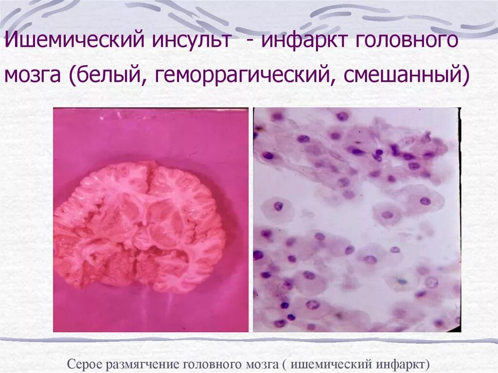 Микропрепарат головного мозга. Геморрагический инфаркт мозга макропрепарат. Геморрагический инфаркт головного мозга патанатомия. Патологическая анатомия макропрепарат ишемический инсульт. Ишемический инсульт мозг макропрепарат.