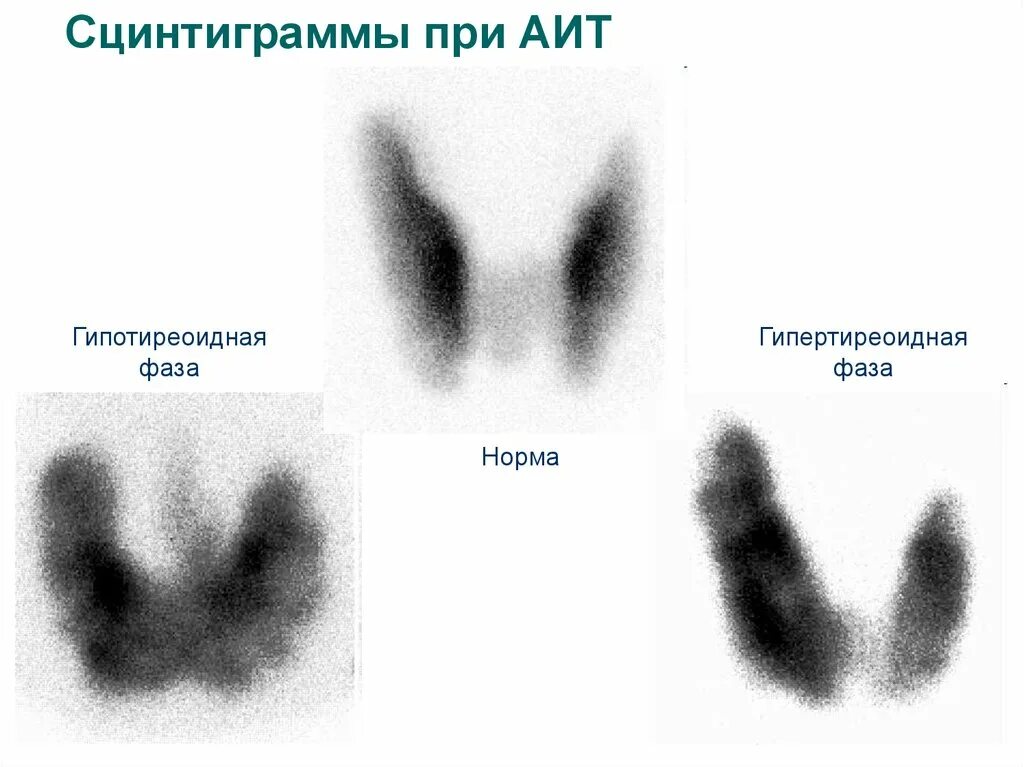 Аутоиммунные изменения щитовидной. Аутоиммунный тиреоидит сцинтиграфия. Подострый тиреоидит щитовидной железы сцинтиграфия. Сцинтиграфия щитовидной железы гипотиреоз. Сцинтиграфия щитовидной железы при подостром тиреоидите.