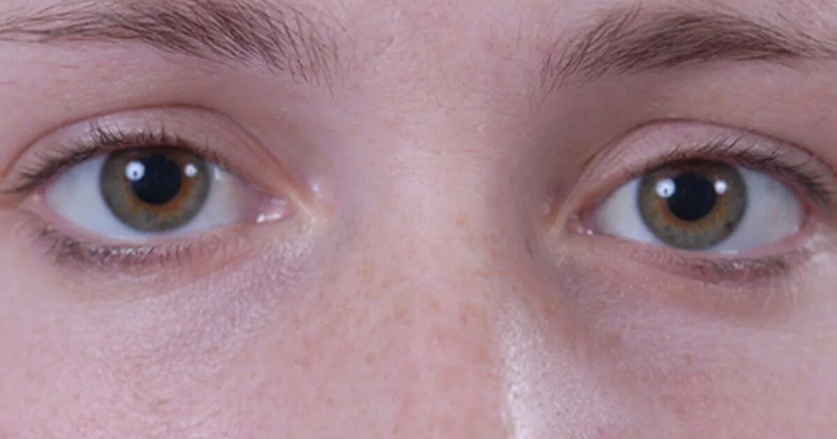 Желтые круги под глазами у мужчин причина. Фиолетовые круги под глазами. Фиолетовые круги вокруг глаз.