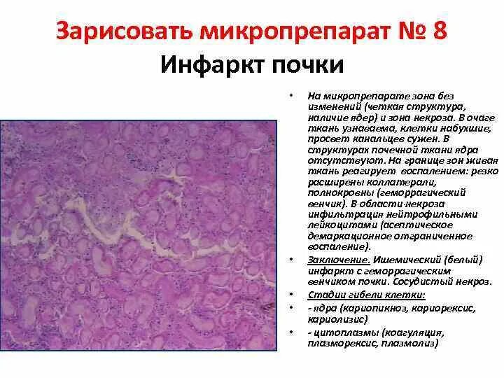 Смешанный периваскулярный инфильтрат при крапивнице
