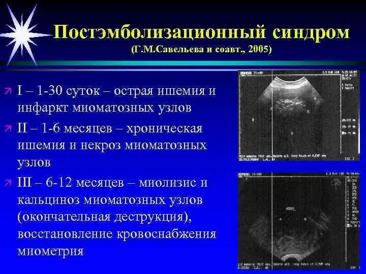 Дегенерация матки. Дегенерация матки. Миома матки мрт картина. Гиалиновая дегенерация миомы. Дегенерация матки.