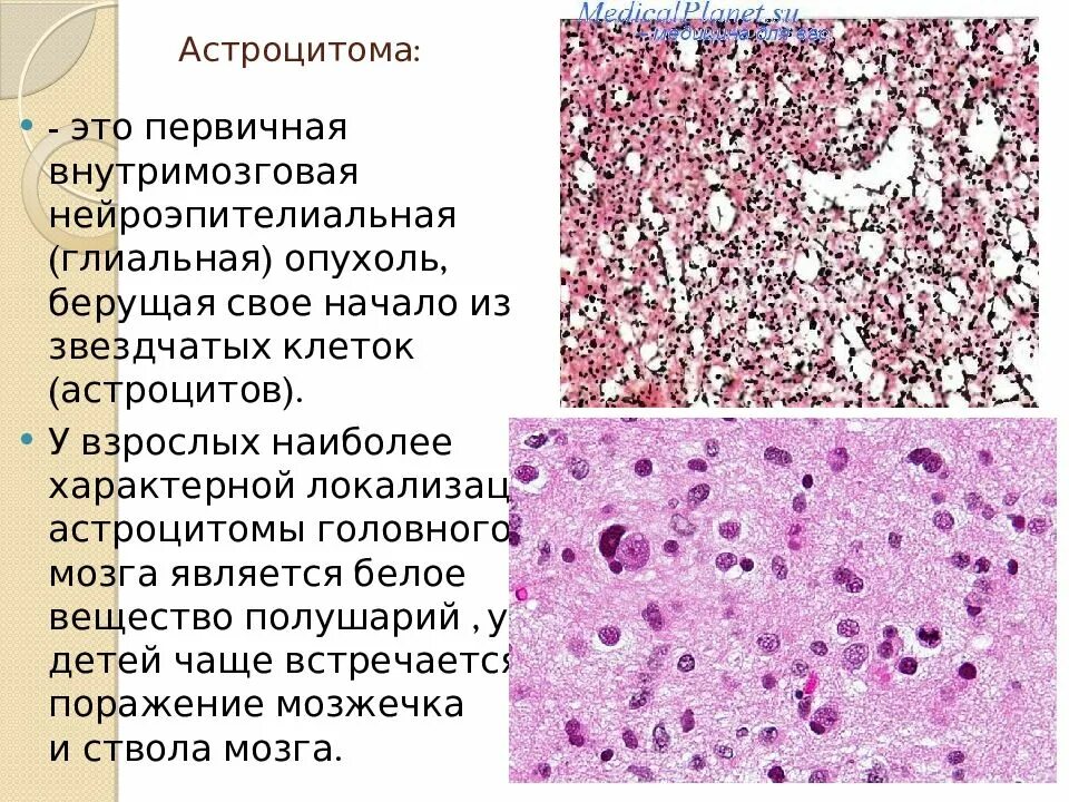 Астроциты мозга. Анапластическая астроцитома гистология. Фибриллярная астроцитома гистология. Астроцитома головного мозга гистология. Фибриллярная астроцитома патанатомия.