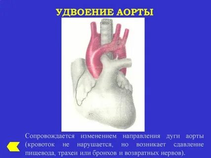 Правая дуга аорты