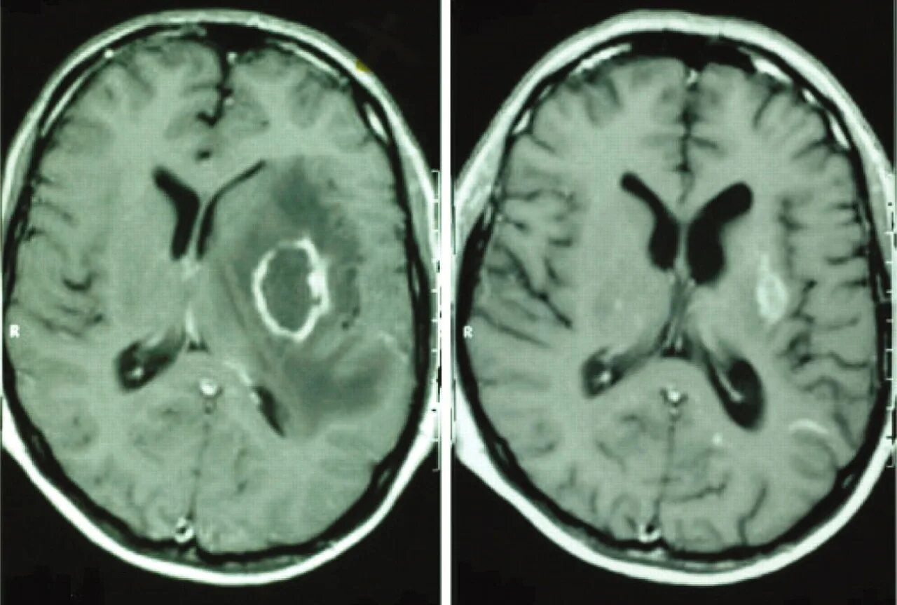 Гнойный мозг. Отогенный менингит. Эпидуральный абсцесс головного мозга мрт. Амебный абсцесс головного мозга. Отогенный менингоэнцефалит.