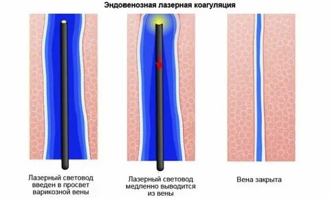 Склеротерапия геморроидальных узлов
