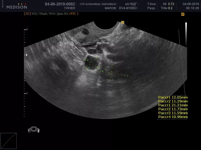 Киста яичника 8мм параовариальная. Параовариальная киста на УЗИ яичника. Параовариальная киста яичника клиника. Параовариальная киста яичника 10мм. Киста яичника orads