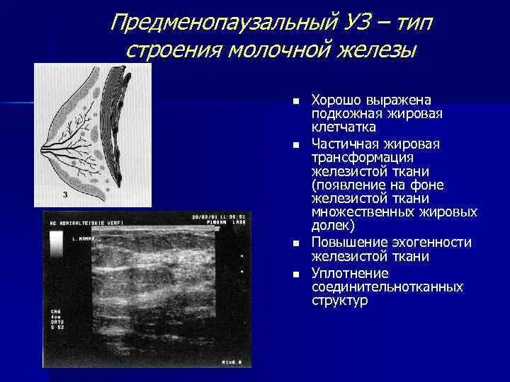 Фиброзно жировая структура. Типы строения молочной железы по узи. строение молочной железы на узи. структура железистой ткани молочной железы. ультразвуковая анатомия молочных желез.