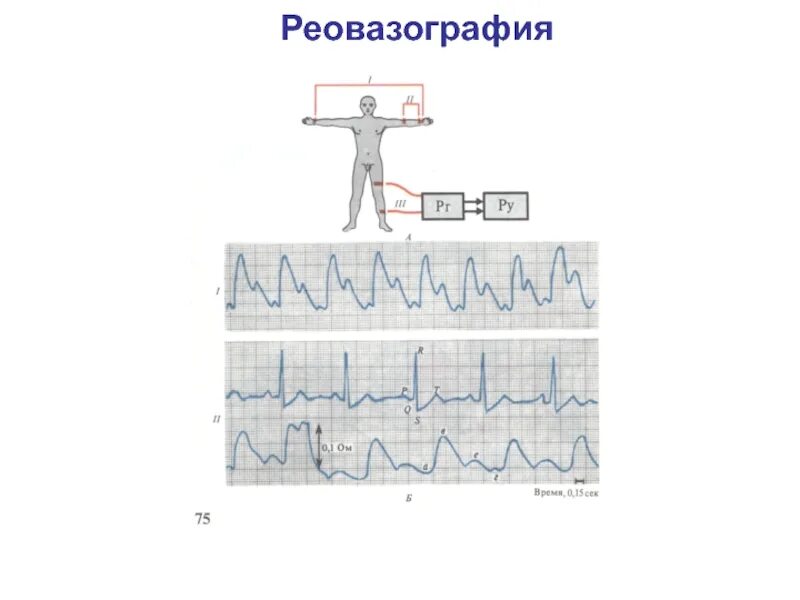 Реовазографии конечностей. Реовазография нижних конечностей норма. реовазография периферических сосудов. реография нижних конечностей.