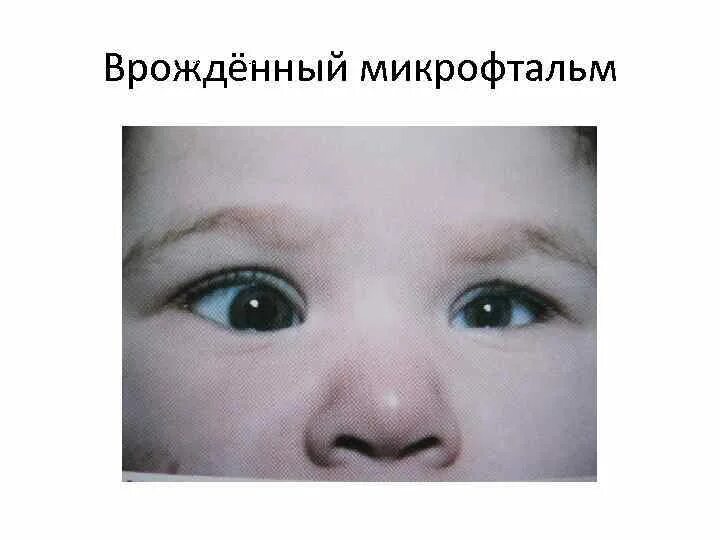 Анофтальм. Микрофтальм анофтальм. микрофтальмия глаза у детей что это. врожденный микрофтальм микрокорнеа. врожденное отсутствие глаз.