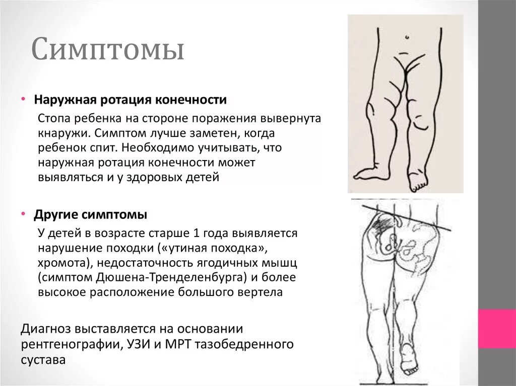 Через сколько ротация. Наружная ротация конечности врожденный вывих бедра. наружная ротация тазобедренного сустава у грудничка. наружная ротация ноги у ребенка. избыточная наружная ротация бедра у ребенка.