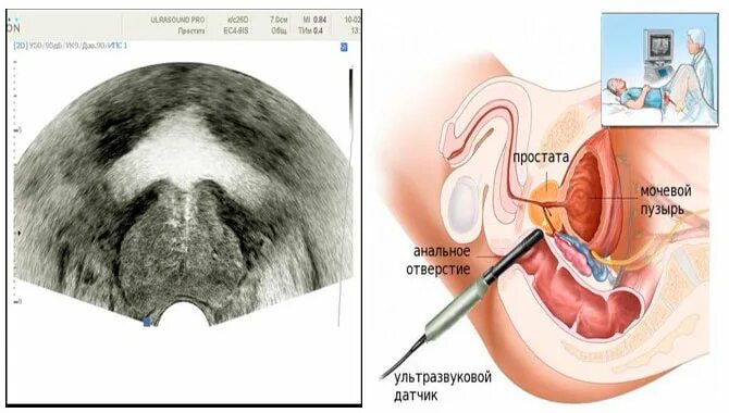 Простаты обучение. Трансректальное УЗИ предстательной железы. УЗИ трузи предстательной железы. Датчик для УЗИ предстательной железы. Трансабдоминальное УЗИ предстательной железы.