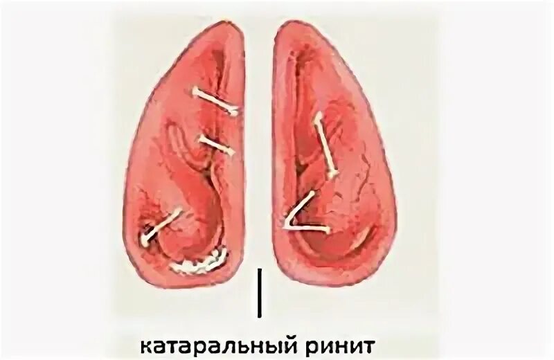 Катаральный насморк. Гипертрофический ринит риноскопия. Вазомоторный ринит пятна Воячека. Вазомоторный гипертрофический ринит. Гипертрофический ринит слизистая.