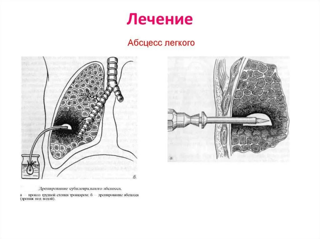 Что такое абсцесс в медицине простыми словами. Чрескожное дренирование абсцесса. дренирование полости абсцесса легкого. дренирование при абсцессе легкого. торакоцентез при абсцессе легкого.