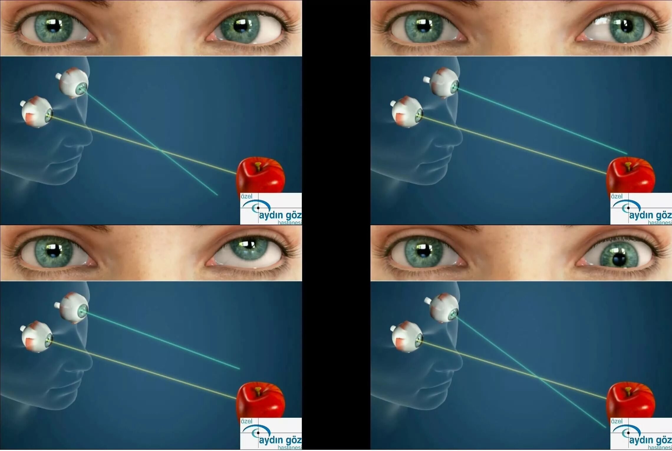 косоглазие причины симптомы. атипичные косоглазия. таблица нарушение зрения косоглазие. ямочки на щеках у детей. страбизм это в медицине.