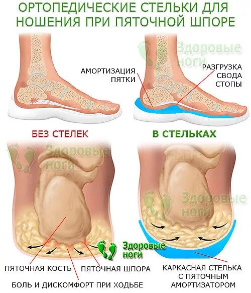 Почему появляется шпора. Как выглядит пятка при пяточной шпоре.