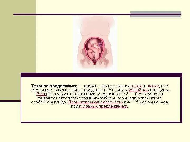 Тазовое предлежание матки