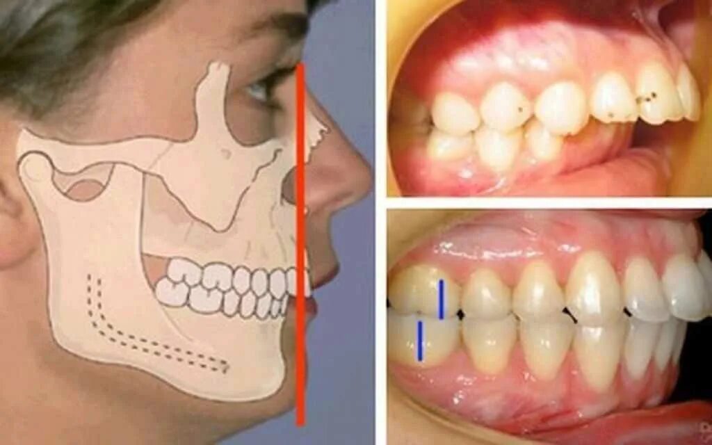 Дистальный прикус верхняя прогнатия. Ортодонт мезиальный прикус. Дистальный (прогнатический) прикус. Мезиальный, глубокий, дистальный прикус. Почему сжата челюсть
