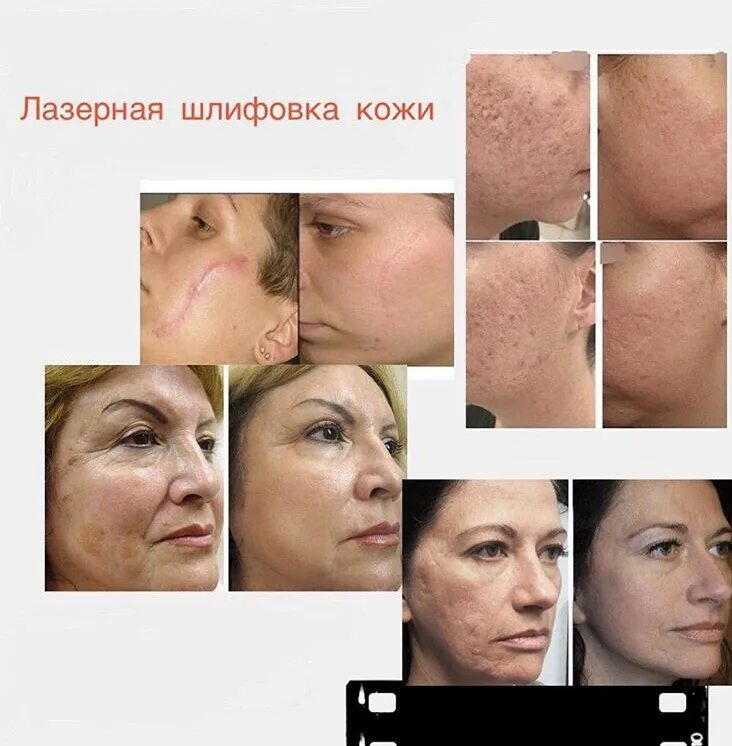 Лазерная шлифовка co2