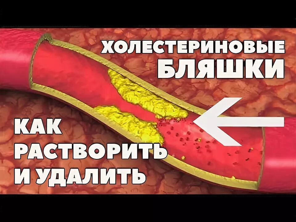 Удаление холестериновых бляшек. Растворение холестериновых бляшек. что растворяет холестериновые бляшки. что растворяет атеросклеротические бляшки. холестерин бляшки в сосудах.