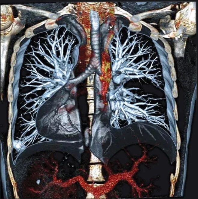 СКТ органов грудной клетки. Компьютерная томография кт грудной клетки. Мультиспиральная кт легких. Мультиспиральная кт грудной клетки.
