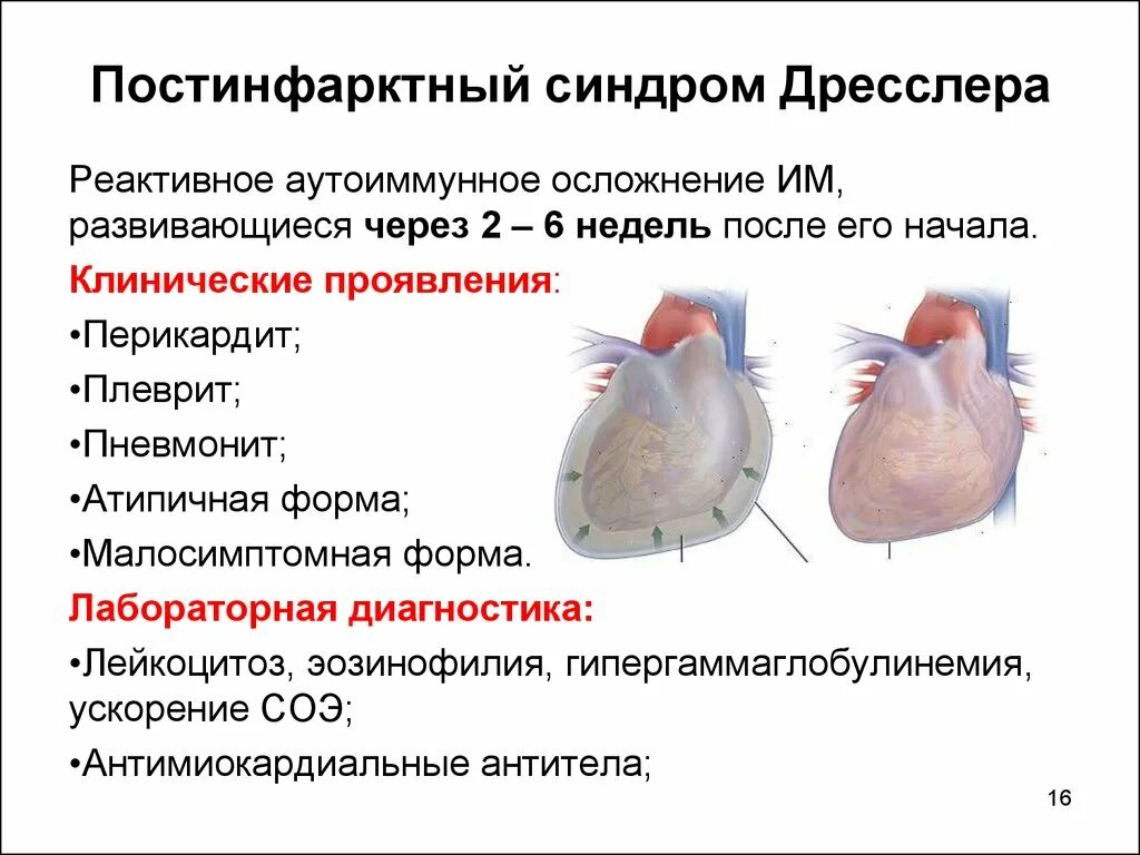 Диагностические критерии синдром Дресслера. Осложнения инфаркта миокарда синдром Дресслера. Экссудативный плеврит при постинфарктном синдроме Дресслера. Синдром Дресслера механизм развития. Осложнения перикардита