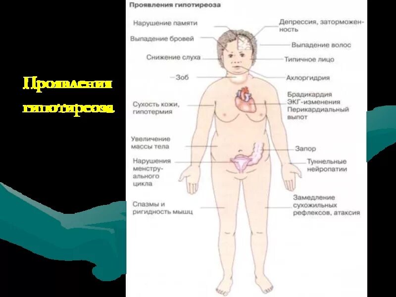 Гипотиреоз проявления. Тяжелая форма гипотиреоза. Гипотиреоз внешний вид.