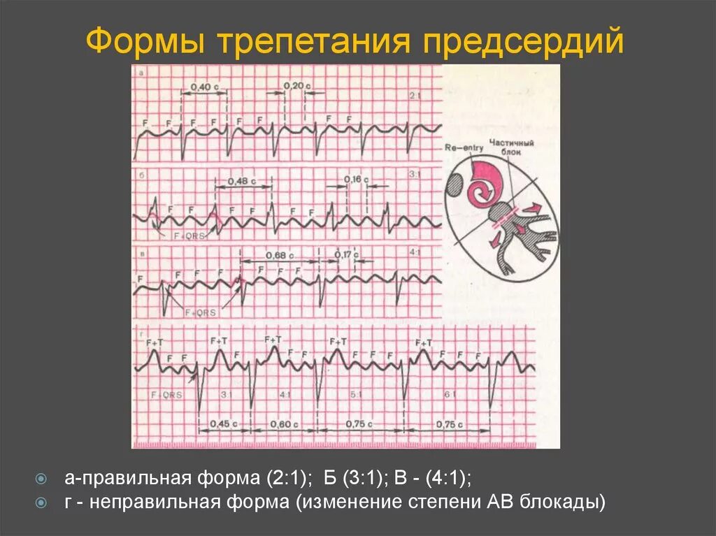 Трепетание предсердий неправильная форма на ЭКГ. Правильная форма трепетания предсердий на ЭКГ. Фибрилляция предсердий правильная форма на ЭКГ. Трепетание предсердий типы 1 и 2. Формы трепетания предсердий