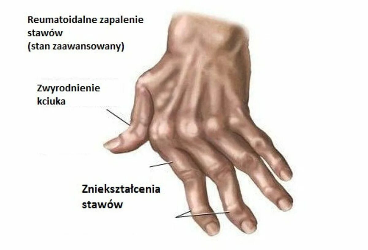 Изменения кисти рук. Ревматоидный артрит деформация кисти. Деформация кисти при ревматоидном артрите. Ревматоидный артрит суставной симптомы. Ревматоидный полиартрит стадии.