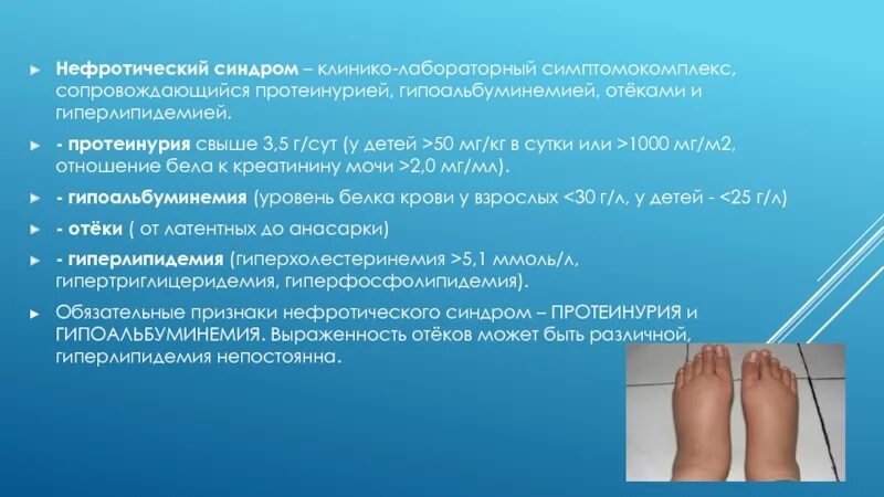Выраженный отечный синдром. Нефротический отечный синдром. для нефротического синдрома отеки. отеки при нефротическом синдроме. нифритический синдром отеки.