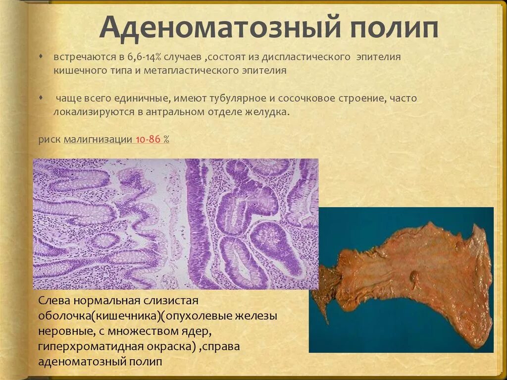 Полип тип 0 1s что это. Аденоматозные полипы гистология. аденоматозный полип желудка гистология. гистологические типы полипов. аденоматозный полип желудка фото.