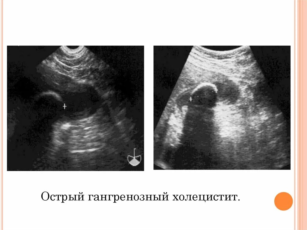 Флегмонозный калькулезный холецистит. Острый гангренозный калькулезный холецистит. Острый гангренозный калькулезный. Калькулезный холецистит узи. Острый флегмонозный калькулезный холецистит.