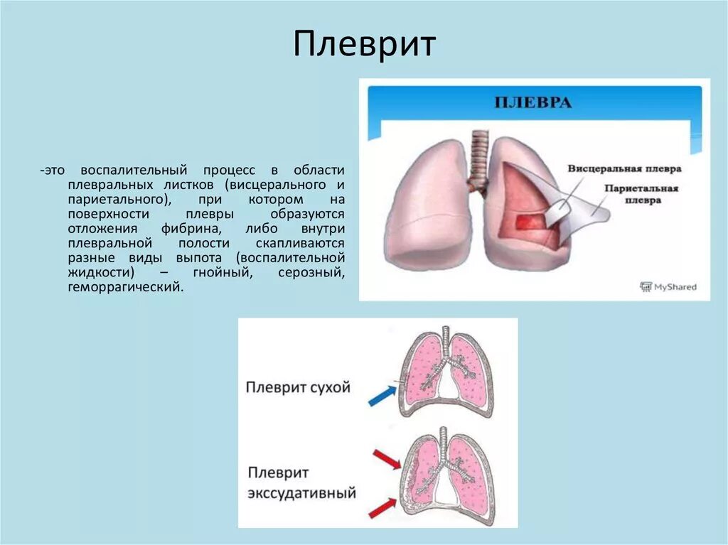 Выпот плевральных листков. Алеврит. Сухой и выпотной плеврит. Плевральные осложнения