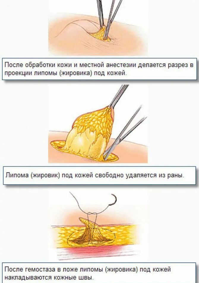 Атерома схема операции. Жировик средства лечения