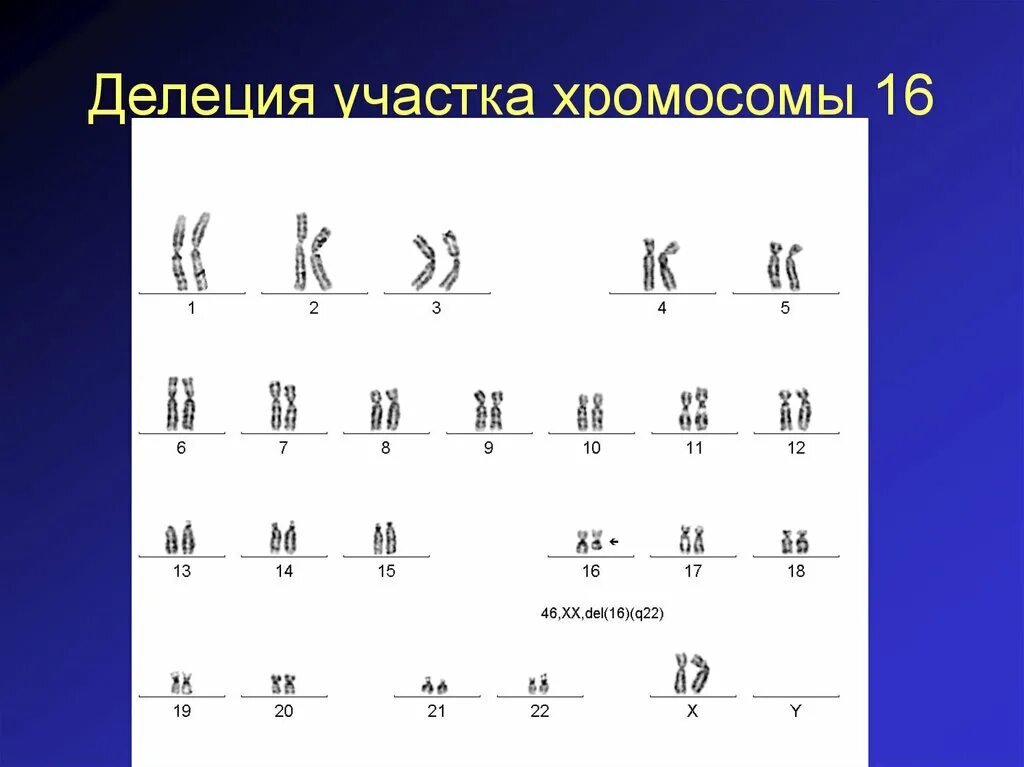 Делеция хромосомы. Делеция участка хромосомы 16. Частичная делеция хромосомы. Кольцевая 4 хромосома