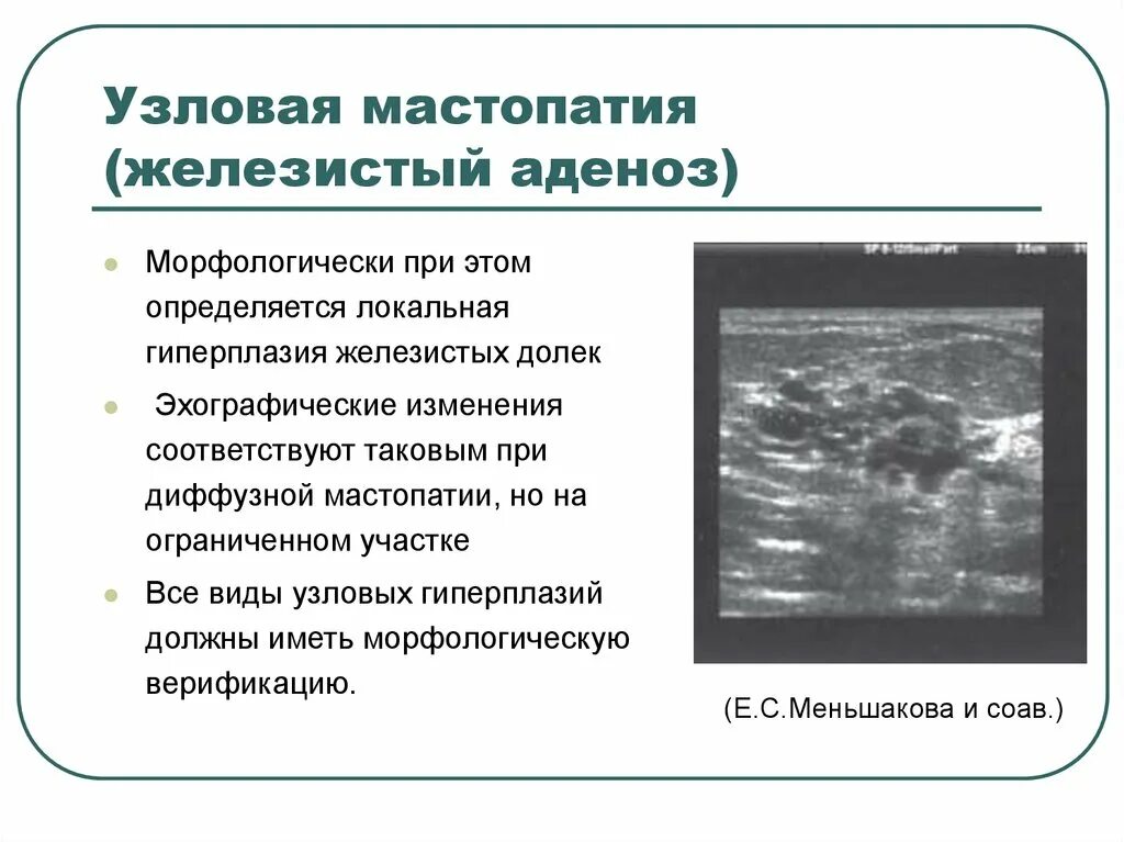 Мастопатия молочной железы на УЗИ. Склерозирующий аденоз молочной железы на УЗИ. Узловая мастопатия молочной железы на УЗИ. Диффузный аденоз