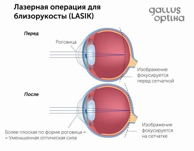 Вылечит ли близорукость операция. Оперированная миопия. Операция от близорукости.