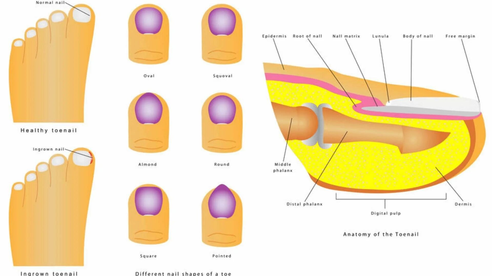 Ногти на ногах. Заросший нигить на большом пальце. Дистальный подногтевой онихомикоз. Как растет ноготь на ноге большого пальца. Ноготь на большом пальце ноги.