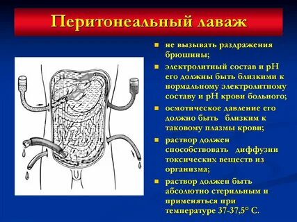 Диализ брюшной полости