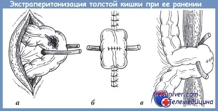 Экстраперитонизация кишки. Экстраперитонизация толстой кишки. Ушивание разрыва прямой кишки.