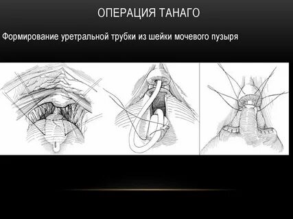 Операция шейки мочевого пузыря