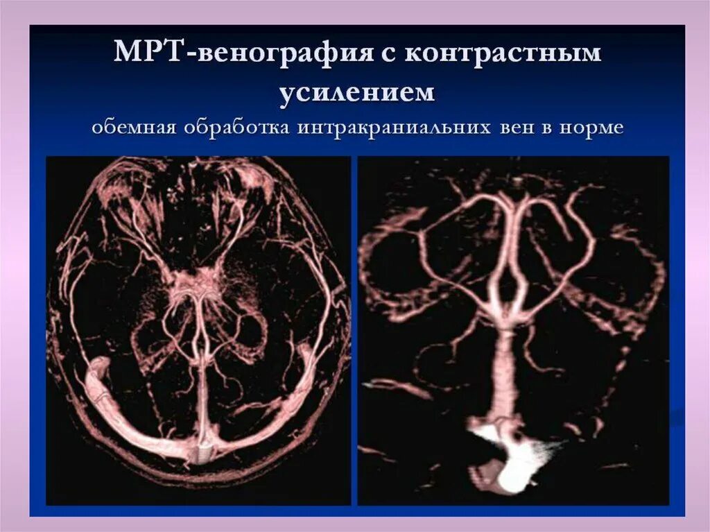 Венография головного мозга. Магнитно-резонансная венография головного мозга. Кт ангиография сосудов головного мозга. Магнитно-резонансная ангиография сосудов головного мозга. Венография головного мозга мрт.