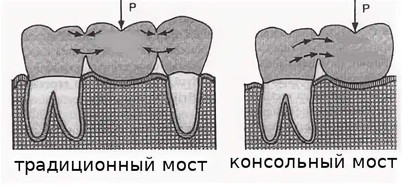 Мост задние зубы. Мост задние зубы