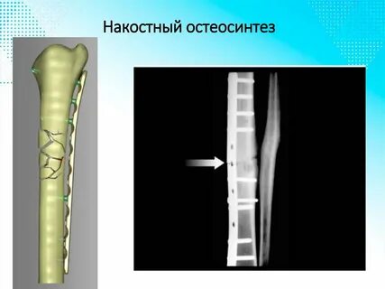 Травматология переломы презентация