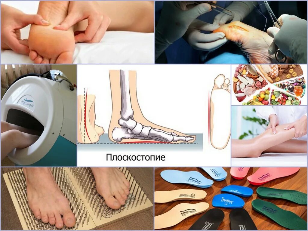 Можно ли избавиться от плоскостопия. Плоскостопие продольное физиотерапия. плоскостопие у взрослых. физиолечение при плоскостопии у взрослых. для исправления плоскостопия.