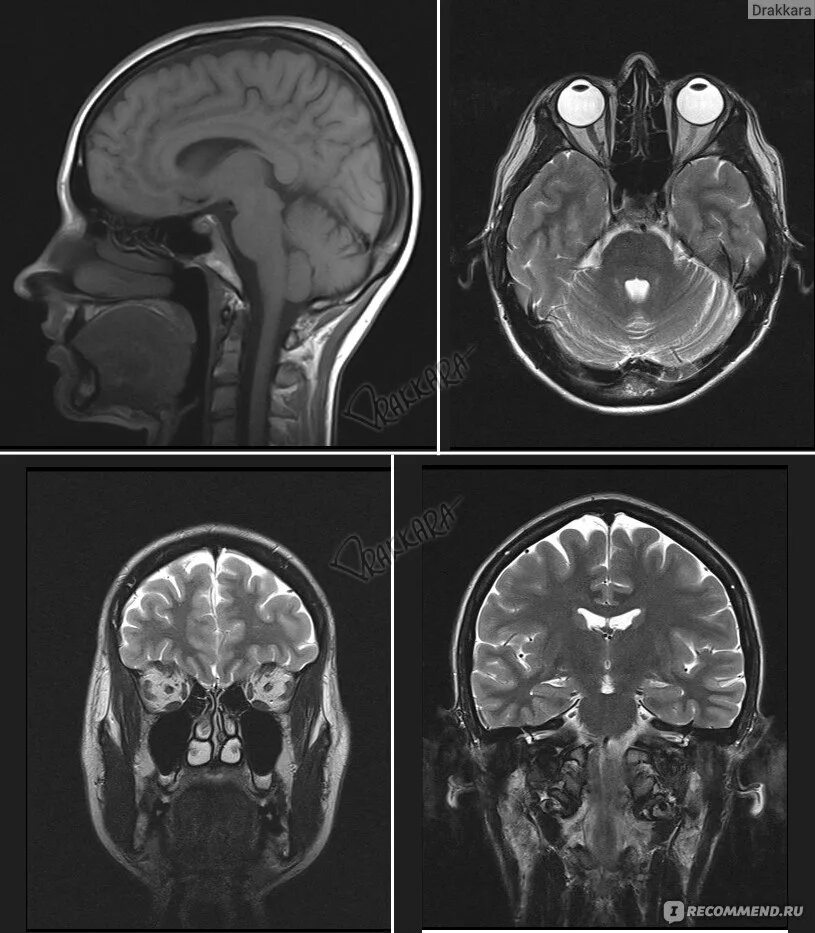 Где можно сделать мрт мозга. Кт томограмма головного мозга. Мрт мозга сбоку. Магнито-резонансная томография головного мозга снимок. Мрт Коронал головного мозга.